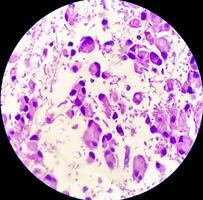 Human meningioma. Meningioma cells are relatively uniform, with a tendency to encircle one another, forming whorls and psammoma bodies, concentric laminated eosinophilic bodies that tend to calcify photo