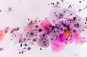Paps smear analysis, Superficial squamous cell, metaplastic squamous cell, koilocytes cell. HPV related change photo