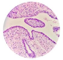 Histopathological photomicrograph of ovarian cyst showing Metastatic cystic teratoma. photo