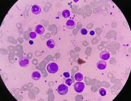 Bone marrow study, Suggestive of reactive marrow with dimorphic Erythroid hyperplasia photo