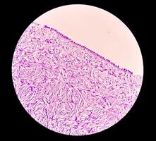 Histology, Peritoneal inclusion cyst. Paraovarian cysts, hydrosalpinx and low-grade cystic mesothelioma are usually considered in the differential diagnosis of PICs. photo