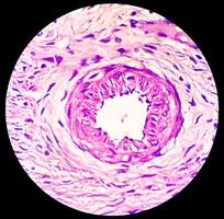 Histology, Peritoneal inclusion cyst. Paraovarian cysts, hydrosalpinx and low-grade cystic mesothelioma are usually considered in the differential diagnosis of PICs. photo