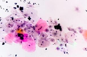 Paps smear analysis, Superficial squamous cell, metaplastic squamous cell, koilocytes cell. HPV related change photo