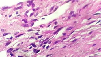 Photomicrograph of histological slide showing Lobular capillary hemangioma on finger. photo