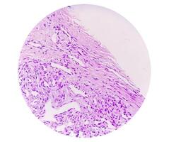Histopathological photomicrograph of ovarian cyst showing Metastatic cystic teratoma. photo