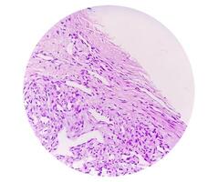 Histopathological photomicrograph of ovarian cyst showing Metastatic cystic teratoma. photo