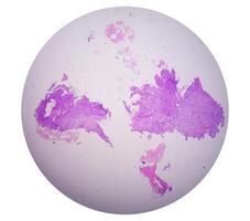 Invasive squamous cell carcinoma of laynx grade 2 photo