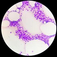 Photomicrograph Bone marrow study, Megakaryocytic Hyperplasia photo