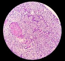 Leg tissue biopsy. Photomicrographic image showing Fibromyxoma. Superficial Acral Fibromyxoma, rare slow growing myxoid tumor. photo