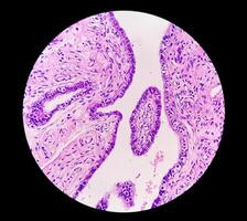 Histopathological photomicrograph of ovarian cyst showing Metastatic cystic teratoma. photo