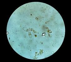 Schistosoma Parasite ova in human urine specimen under microscope. Urinary parasite photo