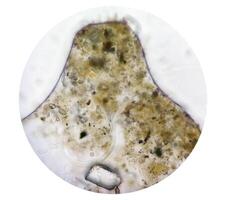 Schistosoma Parasite ova in human urine specimen under microscope. Urinary parasite photo