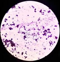 microfotografía de paparazzi frotis. inflamatorio frotis con vaginal candidiasis . médico concepto. foto