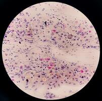 Photomicrograph of Paps Smear. Inflammatory smear with vaginal candidiasis . Medical concept photo