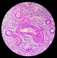 Histology, Peritoneal inclusion cyst. Paraovarian cysts, hydrosalpinx and low-grade cystic mesothelioma are usually considered in the differential diagnosis of PICs. photo