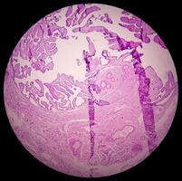 Leg tissue biopsy. Photomicrographic image showing Fibromyxoma. Superficial Acral Fibromyxoma, rare slow growing myxoid tumor. photo