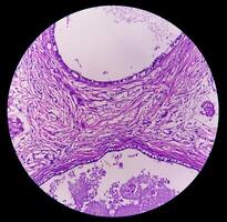Histological Photomicrograph. Prurigo nodularis or PN is a chronic disorder of the skin. photo