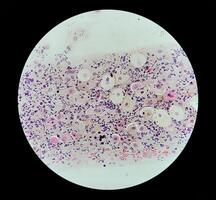 Photomicrograph of Paps Smear. Inflammatory smear with vaginal candidiasis . Medical concept. photo
