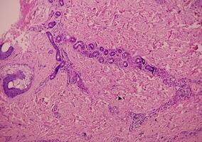 Histological Photomicrograph. Prurigo nodularis or PN is a chronic disorder of the skin. photo