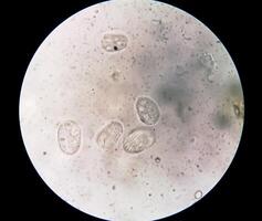 esquistosoma parásito óvulo en humano orina muestra debajo microscopio. urinario parásito foto
