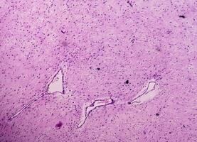 Leg tissue biopsy. Photomicrographic image showing Fibromyxoma. Superficial Acral Fibromyxoma, rare slow growing myxoid tumor. photo