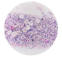 Photomicrograph of Paps Smear. Inflammatory smear with vaginal candidiasis . Medical concept. photo