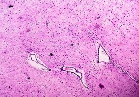 Leg tissue biopsy. Photomicrographic image showing Fibromyxoma. Superficial Acral Fibromyxoma, rare slow growing myxoid tumor. photo