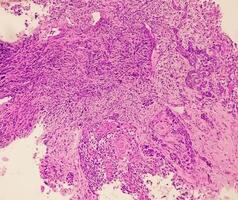 Histological Photomicrograph. Prurigo nodularis or PN is a chronic disorder of the skin. photo