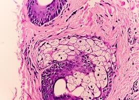 Histological Photomicrograph. Prurigo nodularis is a chronic disorder of the skin. photo