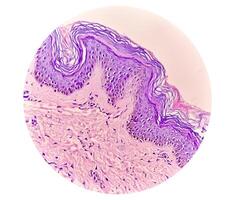 Histological Photomicrograph. Prurigo nodularis or PN is a chronic disorder of the skin. photo