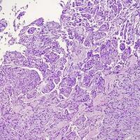 histología, peritoneal inclusión quiste. paraovárico quistes, hidrosálpinx y grado bajo cístico mesotelioma son por lo general considerado en el diferencial diagnóstico de fotos. foto