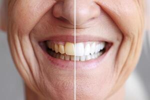 comparación de un mayor mujer sonrisa antes de y después dientes blanqueo foto