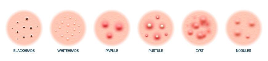 cuerpo piel acné tipo puntos negros, puntos blancos, pápula vector