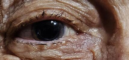 pupil dilation of an elderly woman induced by drops during an eye examination photo