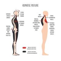 cifótico postura. el lado ver muestra deformación de redondeado espalda, espina curvatura, pelvis rotación, estirado y debilitado, acortado y decenas músculos. vector