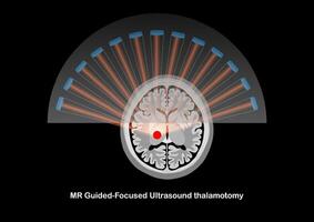 MR-guided focused ultrasound thalamotomy for treatment of tremor vector