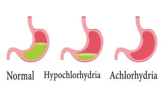 científico diseño de normal célula hipoclorhidria y aclorhidria. vector