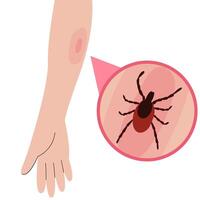 The human hand with the tick bite. Tick bite hand.Tick bite. Healthcare illustration. vector