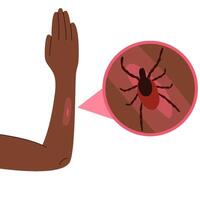 The human hand with the tick bite. Tick bite hand.Tick bite. Healthcare illustration. vector