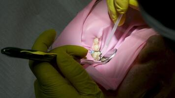 Dentist and assistant drilling tooth in dental clinic. Close-up shot of unrecognizable female patient wearing rubber dam and getting dental treatment video