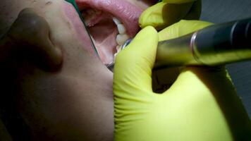 vrouw tandarts installeren een beugel naar geduldig, dichtbij omhoog. langzaam beweging effect video