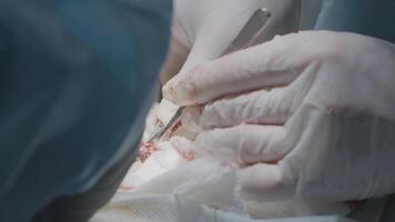 médecins effectuer opération à retirer annexe. action. chirurgiens fonctionner sur la personne en dessous de anesthésie. tumeur suppression et organe chirurgie video