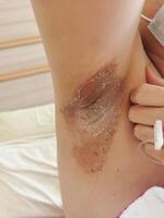Itchy rash allergic rash has skin symptoms. photo