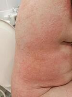 Itchy rash, allergic rash, has skin symptoms. photo