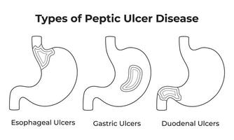 Types of Peptic Ulcer Disease Science Design Illustration vector