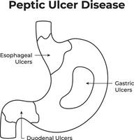 Peptic Ulcer Disease Science Design Illustration. vector