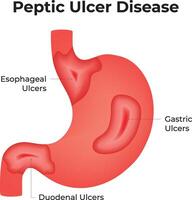 Peptic Ulcer Disease Science Design Illustration. vector