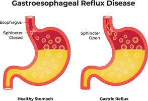 Gastroesophageal Reflux Disease Design Illustration vector