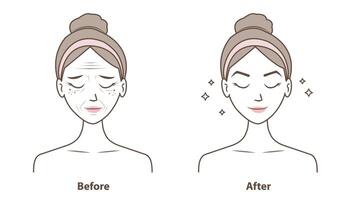 Before and after wrinkles on woman face illustration isolated on white background. Comparison of aging, damaged and beauty skin in cartoon style. Skin care and beauty concept. vector