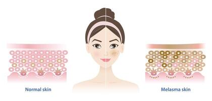 Comparison of normal and melasma skin on woman face illustration on white background. Diagram of healthy epidermis skin layer, melasma and dark spots. Skin care and beauty concept. vector